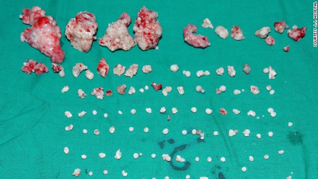 The teen had 232 denticles removed -- doctors said it was a dangerous operation.