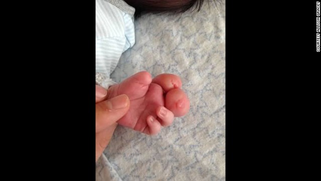 Still, Gracey could not imagine amputating his two swollen fingers. "I knew that he used those fingers. He used them to put his pacifier back in and to rub his eyes."