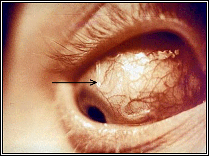 Guinea worms inside human eye.