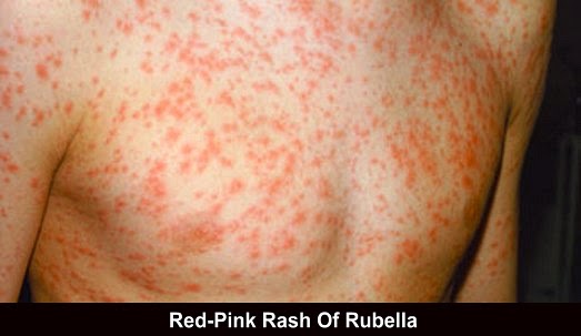 Red-Pink Rash Of Rubella