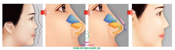 Phẫu thuật nâng mũi như thế nào