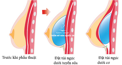Nâng ngực nội soi tại TPHCM