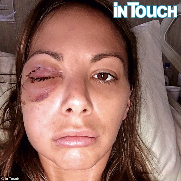 Vanderpump Rules star Kristen Doute unveiled a grisly picture of her bruised eye following her reconstructive surgery to mend three orbital socket fractures
