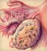 Ovarian cancer illustration