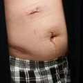 After Laproscopic Kidney Donation stitches and bloated