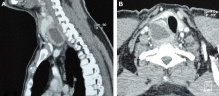 CT scan, coronal (A) and axial (B) section showing a neck mass displacing the ...