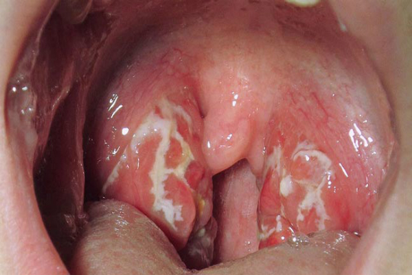 Get Rid Of Your Strep Throat Without The Help Of Antibiotics!