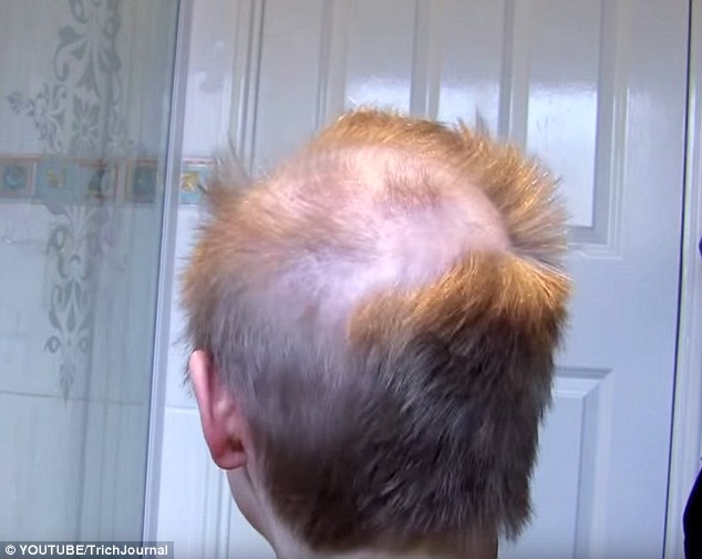 The video also included clips from 2011, the last time she shaved her head. This image shows the damage to her scalp at the time, caused by her disorder