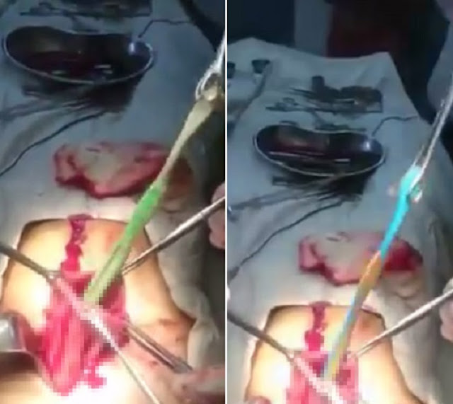 Surgeons Removing More Than 20 TOOTHBRUSHES From Patient's Stomach