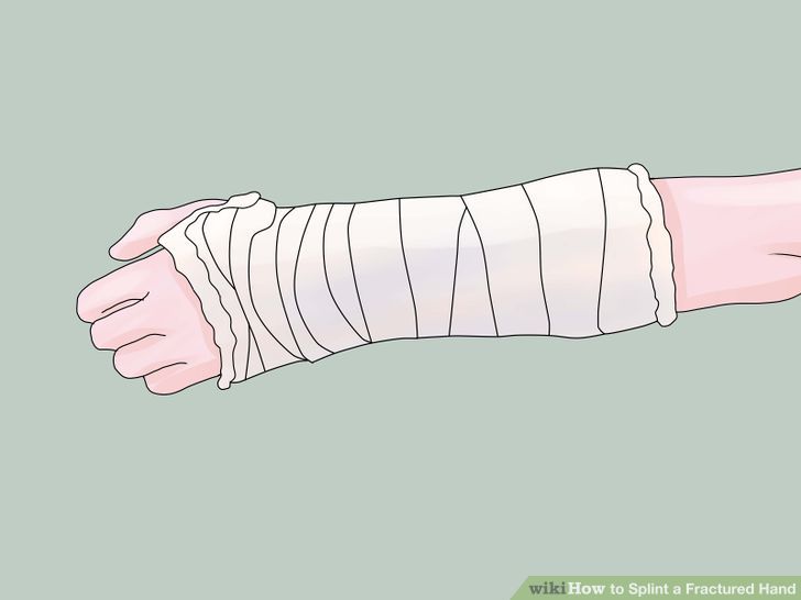 Splint a Fractured Hand Step 3.jpg