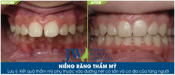 Khách hàng trước và sau khi niềng răng thẩm mỹ tại Nha khoa Bệnh viện thẩm mỹ JW Hàn Quốc