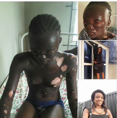 Pretty 21-Year-Old Model Cries For Help After Being A Victim Of Gas Explosion. Graphic Photos