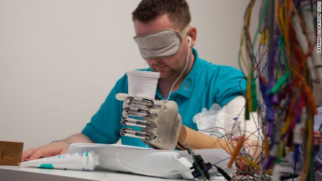 Dennis Aabo Sorensen wears an artificial hand enabled for sensory feedback.