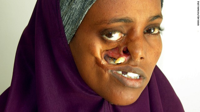 The shrapnel created a hole in Ayan's face, making it impossible for her to close her right eye and difficult to eat. Doctors plan to close the gap and repair the area using tissue from her forearm.