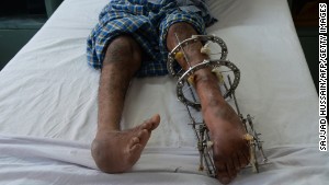 A polio patient lies on a bed during treatment at St. Stephen\'s Hospital in New Delhi, India. 