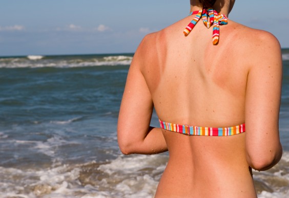 What Really Causes a Sunburn ( And How to Fix it Fast!)