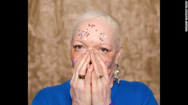 Vitiligo affects roughly 100 million people worldwide, according to the <a href='http://ift.tt/1lq3yHU' target='_blank'>Vitiligo Research Foundation</a>. Pictured, Teri Martin.