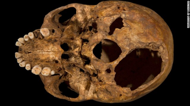Scientists at the University of Leicester say their examination of the skeleton shows Richard met a violent death: They found evidence of 11 wounds -- nine to the head and two to the body -- that they believe were inflicted at or around the time of death. Here, the base of the skull shows one of the potentially fatal injuries. This shows clearly how a section of the skull had been sliced off.