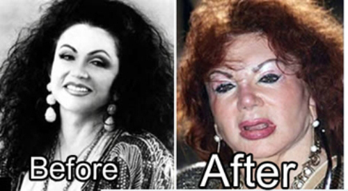 صور - قبل و بعد العمليات التجميلية ! (7)