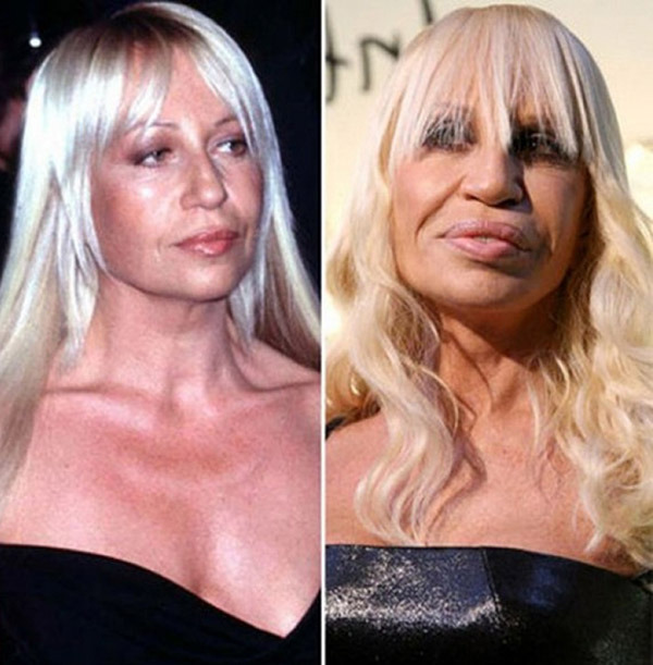 صور - قبل و بعد العمليات التجميلية ! (10)