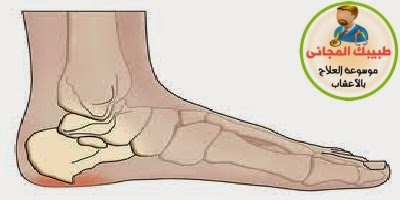  أعراض وأسباب شوكة القدم وعلاجها للدكتور أمير صالح