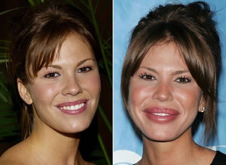 صور - قبل و بعد العمليات التجميلية ! (1)