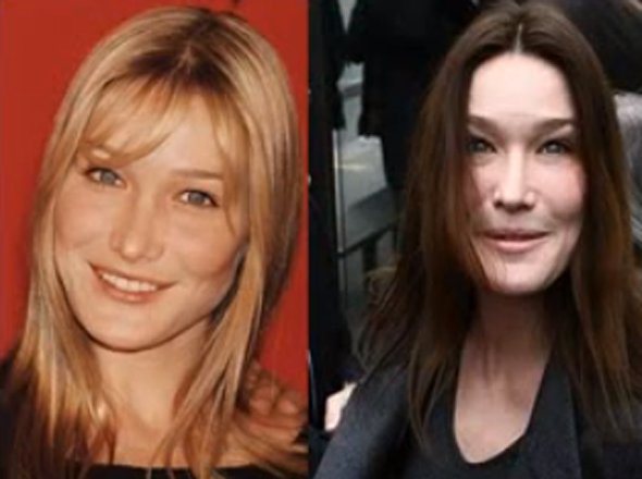 صور - قبل و بعد العمليات التجميلية ! (12)