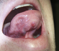 Superficial mucocele on the ventral tongue.