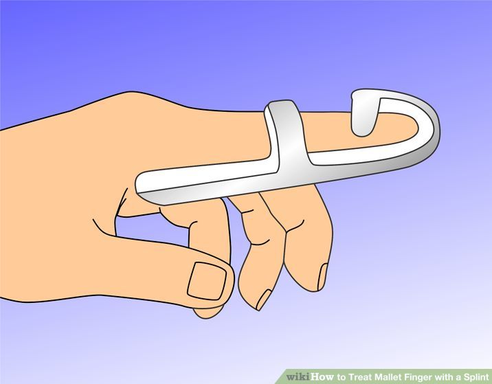 Treat Mallet Finger with a Splint Step 6.jpg