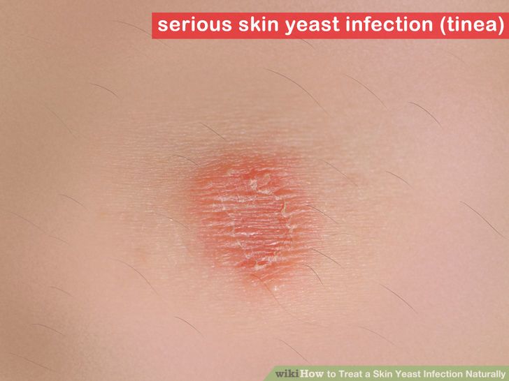 Treat a Skin Yeast Infection Naturally Step 1 Version 2.jpg