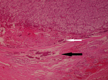 Histological appearance of parathyroid carcinoma with the presence of vascular ...