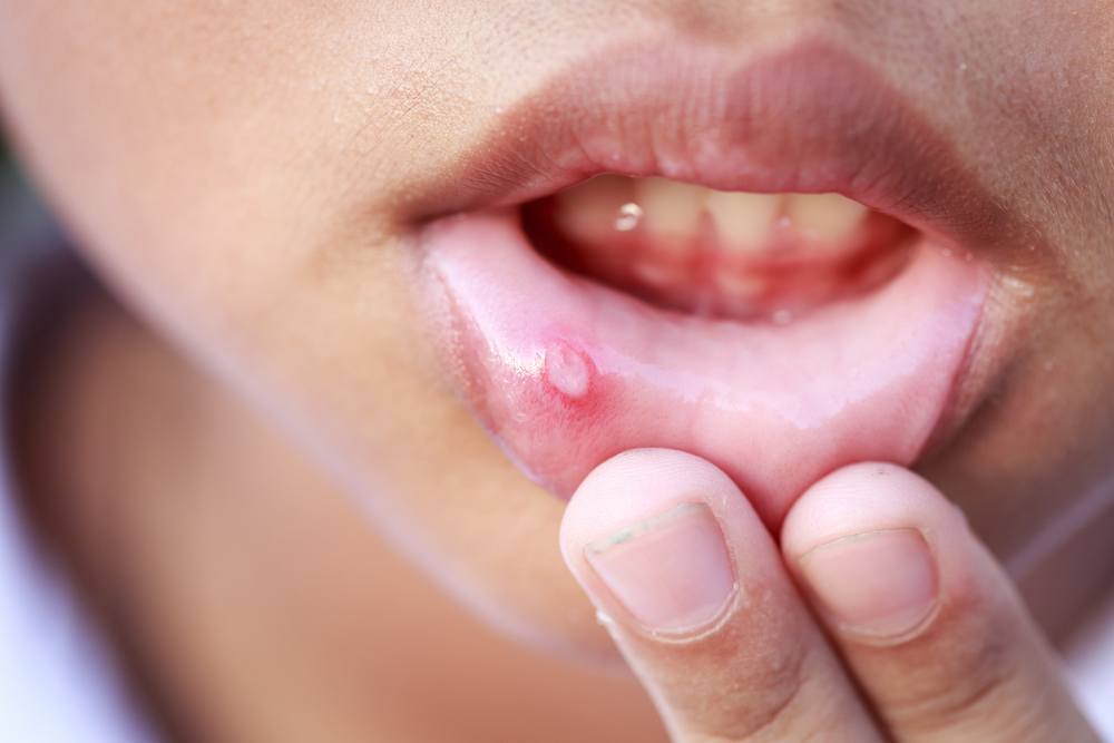 get rid of canker sores