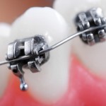 shutterstock_72458023-Dental-braces-supe