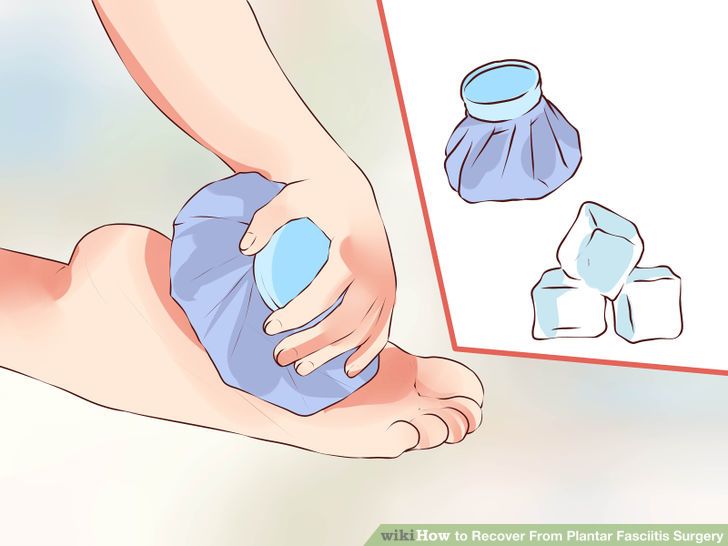 Recover From Plantar Fasciitis Surgery Step 13.jpg