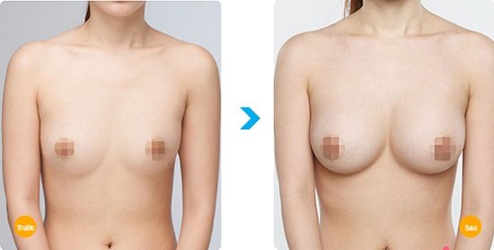 Trước và sau khi nâng ngực nội soi của cô nàng