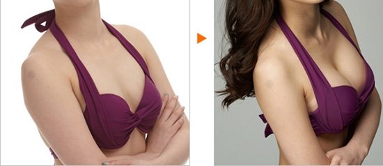 Kết quả trước và sau khi nâng ngực nội soi