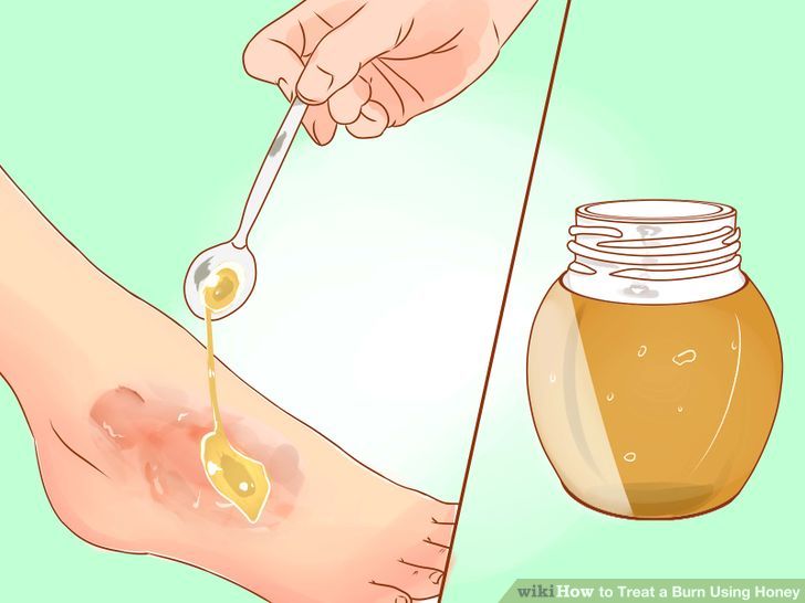 Treat a Burn Using Honey Step 5 Version 3.jpg