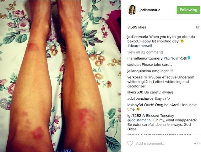 LOOK: Jodi Sta. Maria Suffers Minor Leg Bruises After Taping!
