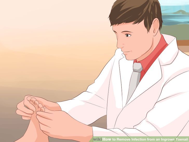 Remove Infection from an Ingrown Toenail Step 4 Version 3.jpg
