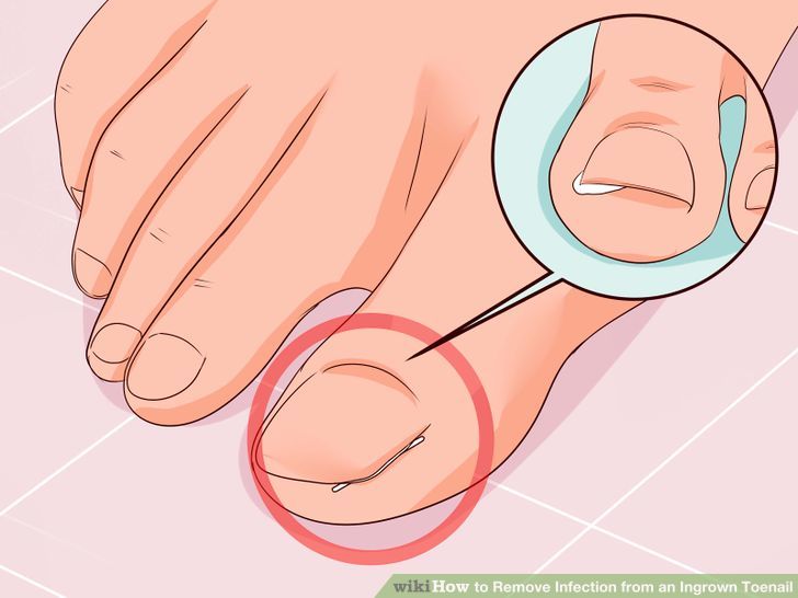 Remove Infection from an Ingrown Toenail Step 2 Version 3.jpg