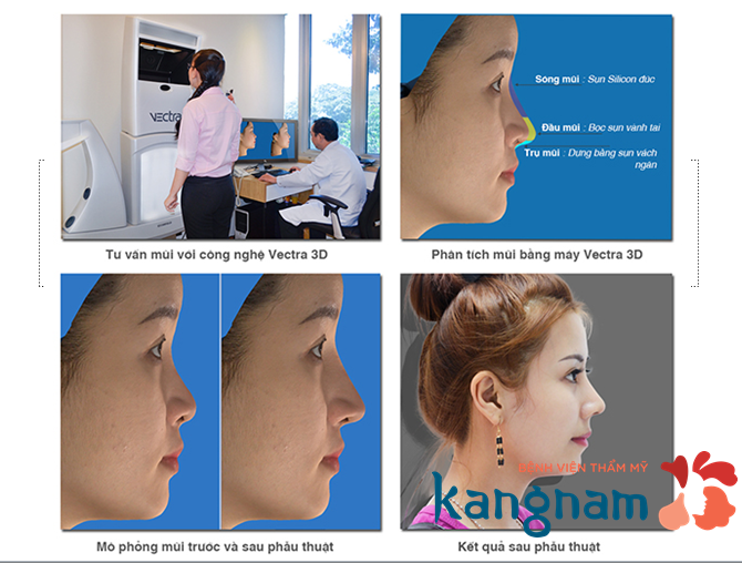 Mô hình nâng mũi bằng sụn sườn tại Kangnam