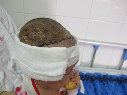 Bé gái 2 tuổi bị lột toàn bộ da đầu vì tai nạn giao thông - 2