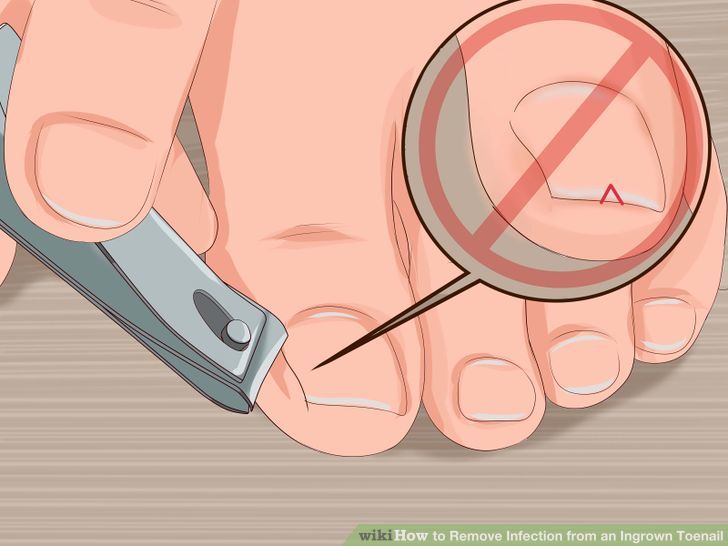 Remove Infection from an Ingrown Toenail Step 8 Version 2.jpg
