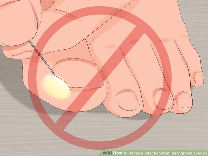 Remove Infection from an Ingrown Toenail Step 7 Version 2.jpg