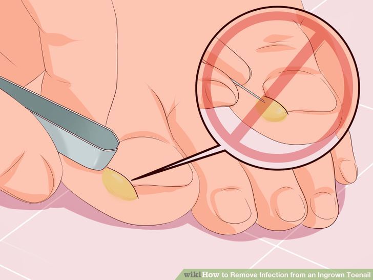 Remove Infection from an Ingrown Toenail Step 6 Version 2.jpg