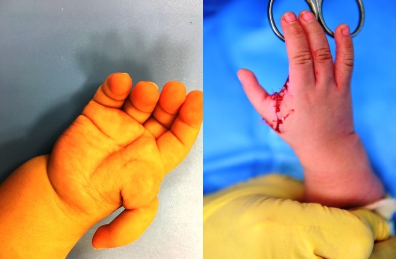 “Biến” ngón trỏ thành ngón cái cho bé trai 1 tuổi