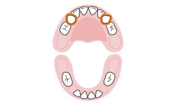 التسنين عند الاطفال الأسنان اللبنية النابان العلويان