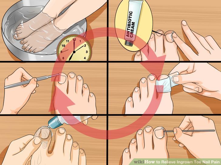 Relieve Ingrown Toe Nail Pain Step 20 Version 2.jpg
