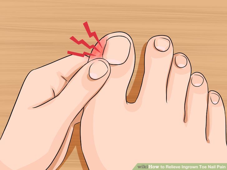 Relieve Ingrown Toe Nail Pain Step 2 Version 4.jpg