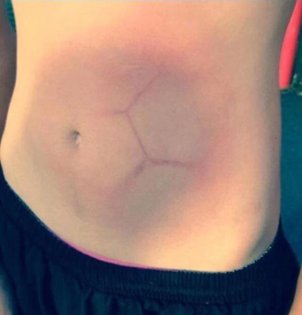 She was hit by, she was struck by, a fast soccer ball
